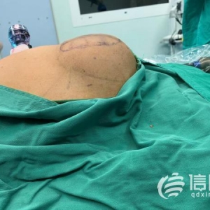 勿以“疝”小而不為 專(zhuān)家建議：及早干預(yù)才是明智之選